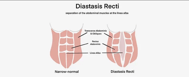 Diastasis Recti