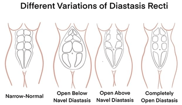 Different Variation of Diastasis Recti